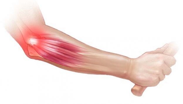 Tennis Elbow | DC Injury Clinic